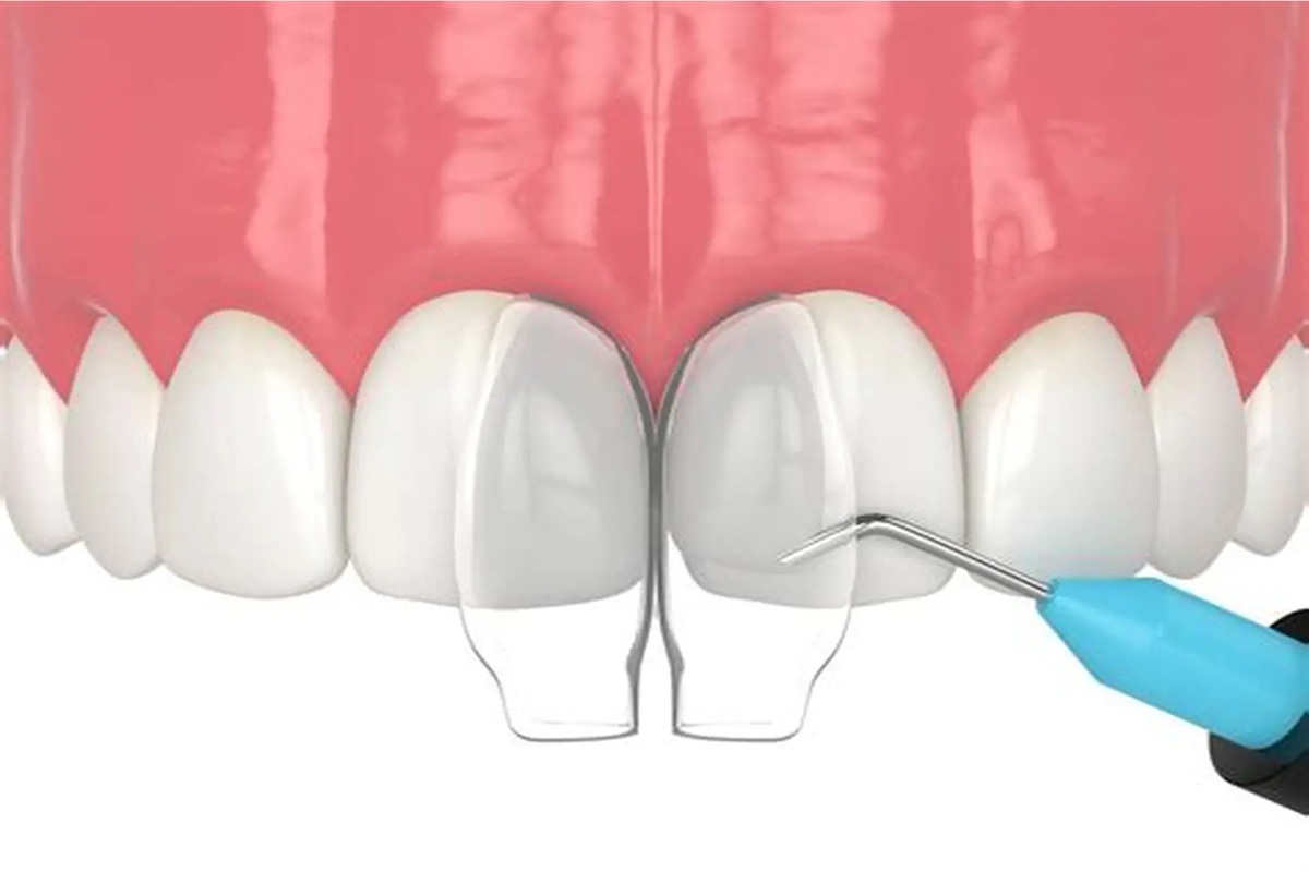 Dental Bonding Consultation