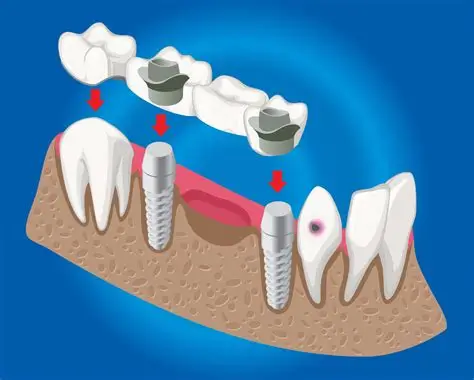 Dental Bridge Treatment