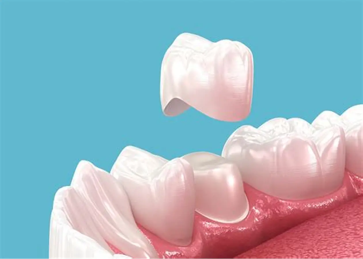 Professional Dental Crowns
