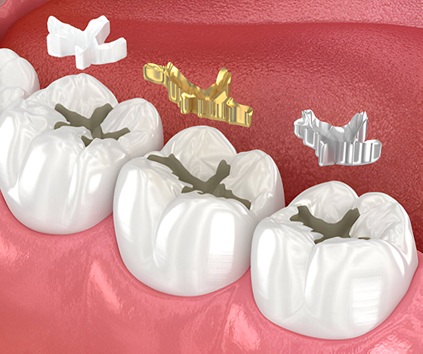 Dental Filling Treatment