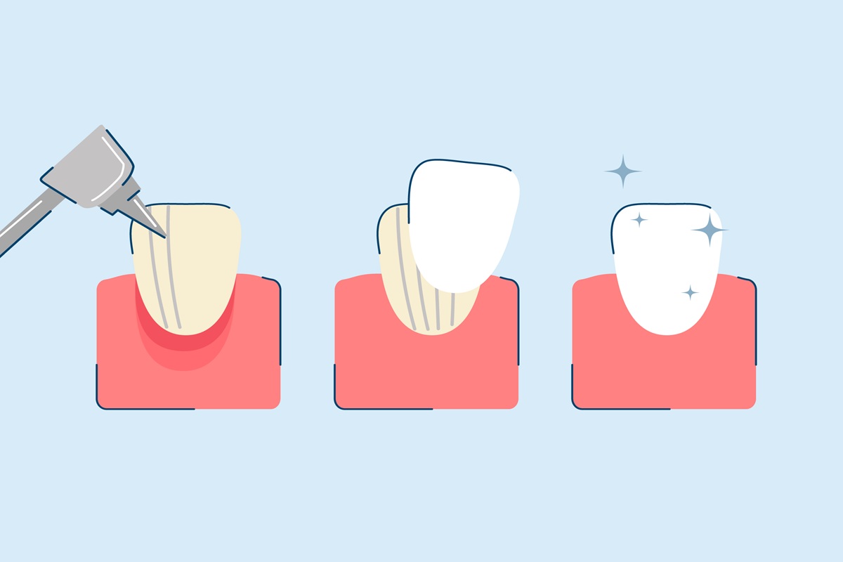 Dental Veneers Consultation