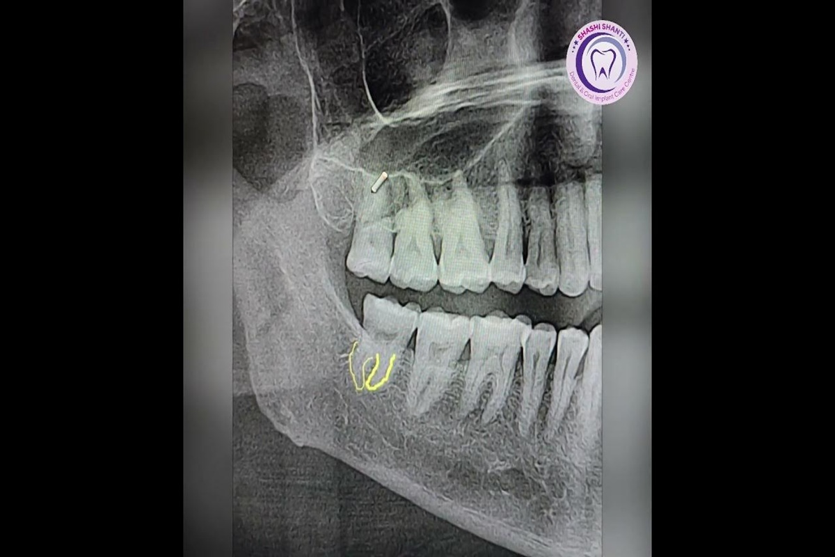 Professional Disimpaction of 3rd Molar