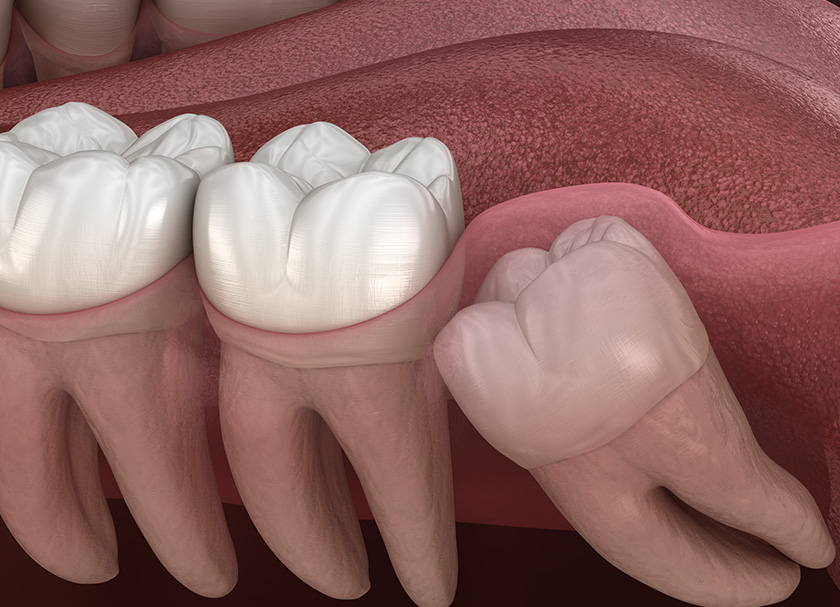 3rd Molar Surgery Treatment
