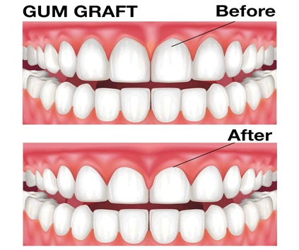Advanced Gum Surgery Treatment