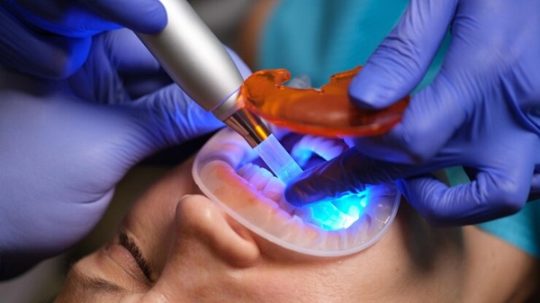 Dental Filling Treatment