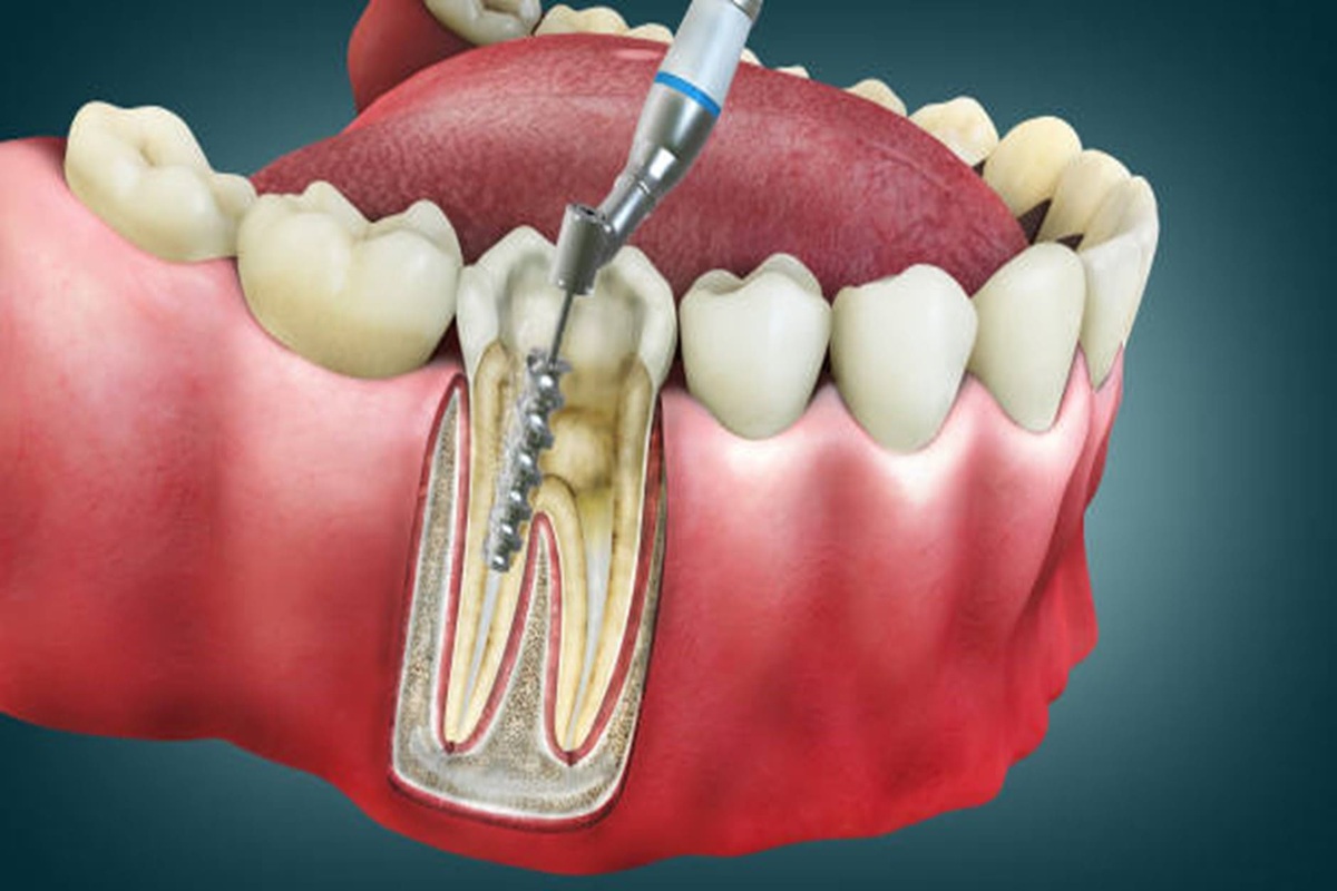 Best Root Canal Treatment at Root Care Dental Clinic