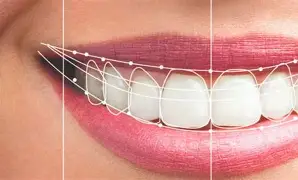 Smile Designing Before and After