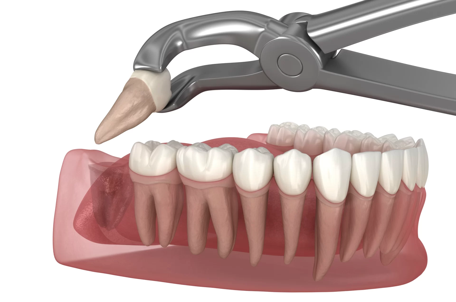 Professional Tooth Extraction