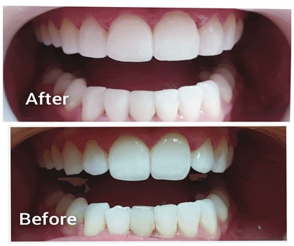 Dental Bonding Before and After