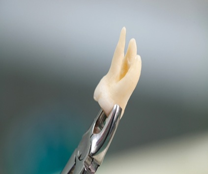 Impacted Wisdom Tooth Removal
